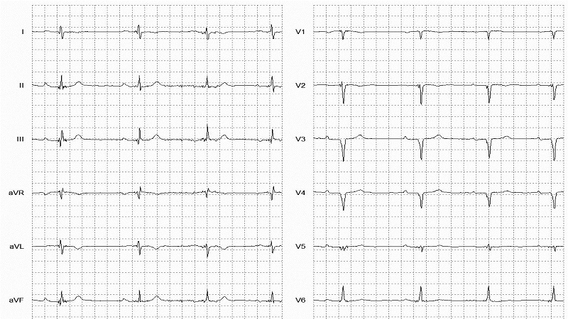 Wandering Atrial Pacemaker 12 Lead EKG